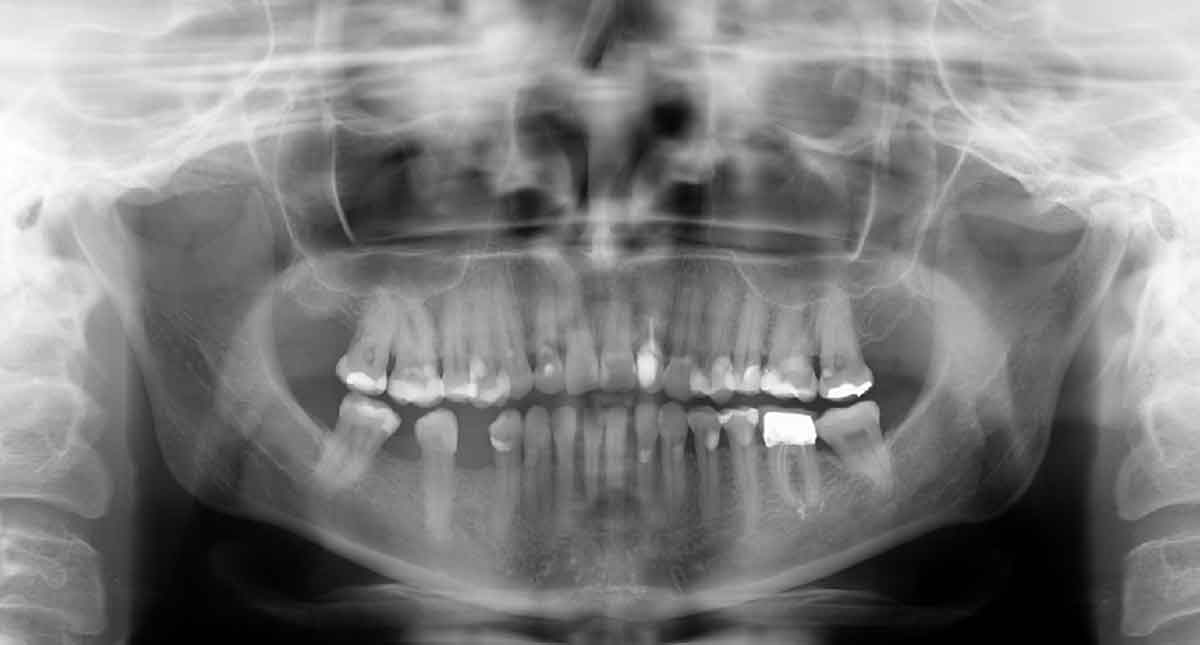 Xray example