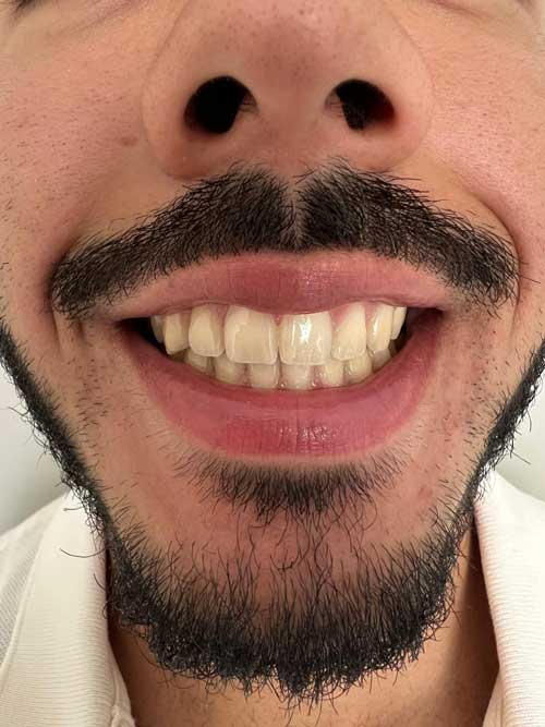 example Smile with teeth in contact
