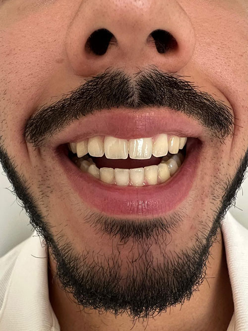 example Smile with teeth slightly apart